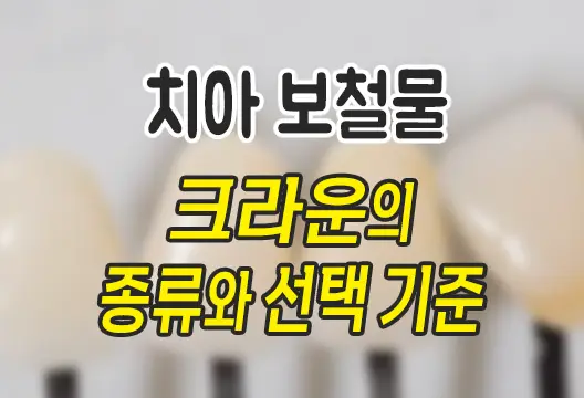 치과치료 치아 보철물 크라운의 종류와 선택 기준